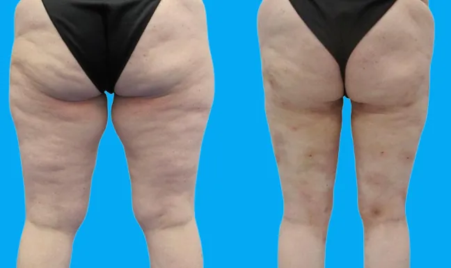 Résultats avant / après lipœdème – photo 3